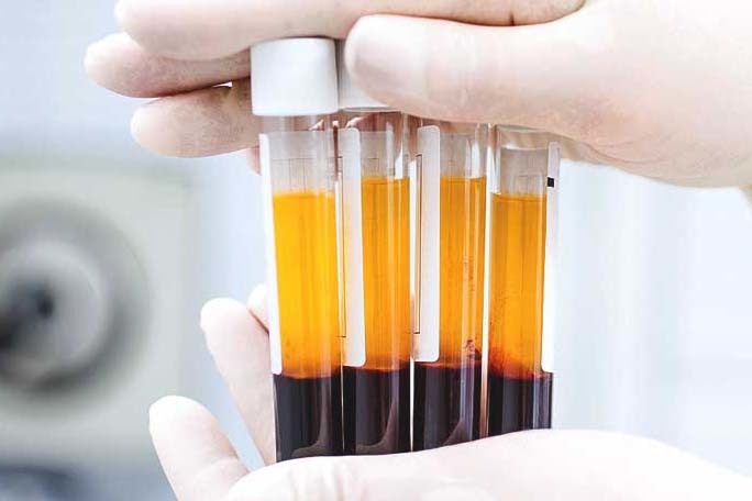 Prospective Evaluation of Platelet-Rich Plasma and Bone Marrow Concentrate Treatment to Accelerate Healing After Anterior Cruciate Ligament Reconstruction