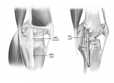 Medial Collateral Ligament Reconstruction Video